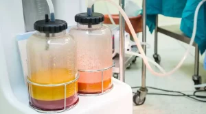 02 - liposuction vs coolsculpting